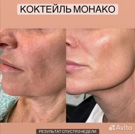 Мезоботокс, Коктейль Монако