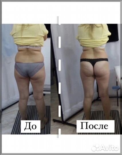 5 процедур для похудения