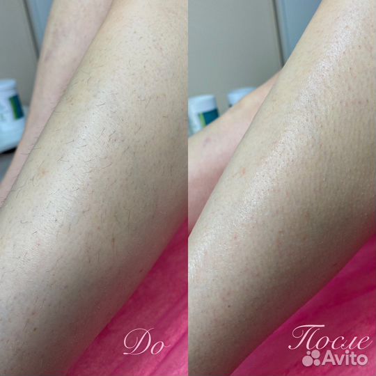 Шугаринг женский сжм