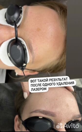 Лазерное удаление татуажа, перманента, тату