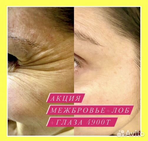 Врач, косметолог ботокс губы