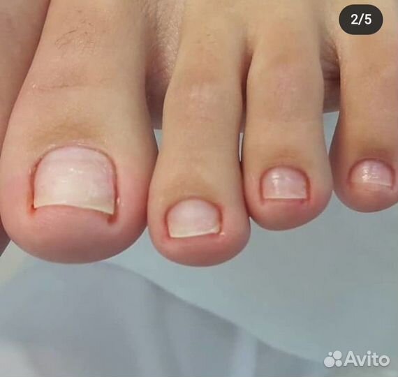 Медицинский педикюр вросший ноготь