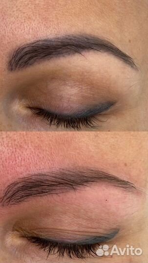 Лазерное удаление татуажа тату бесплатно