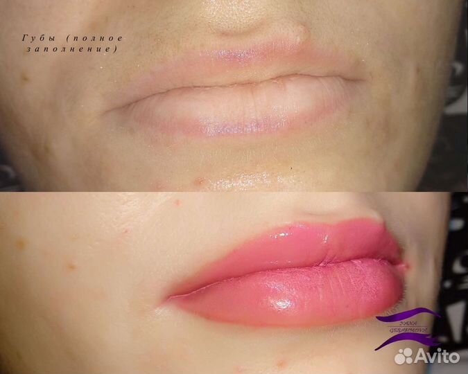 Татуаж, исправление, удаление, комуфляж шрамов