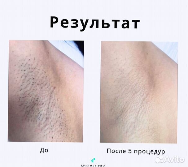 Аппарат для эпиляции Lumines’ Макс Ван 1200