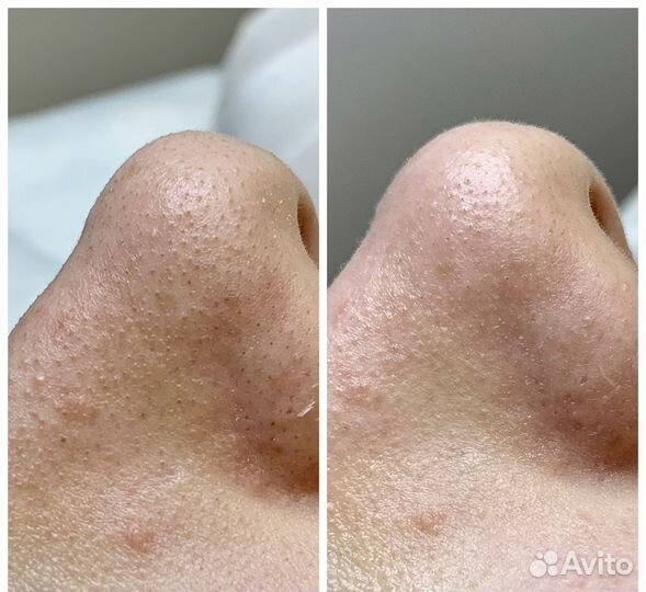 Классический массаж лица