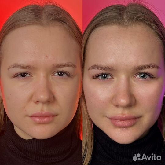 Контурная пластика лица.Full Face.Профиль Джоли