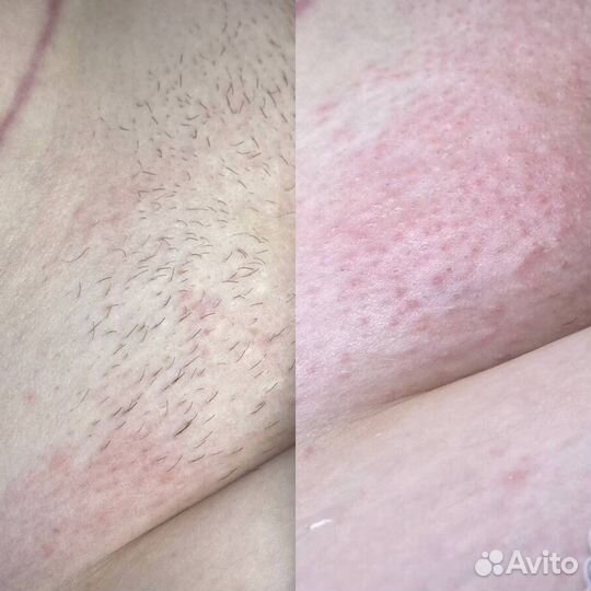 Электроэпиляция