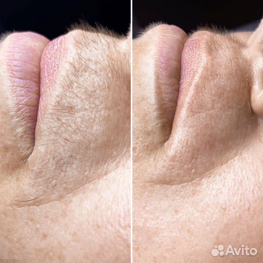 Электроэпиляция Без Боли