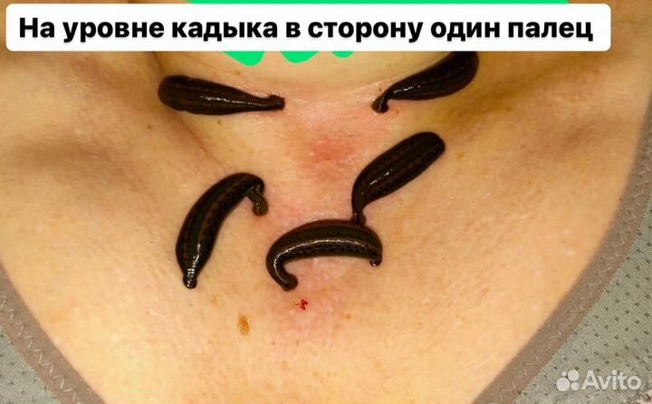 Пиявки медицинские