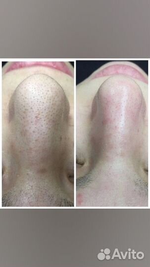 Чистка лица гостиный двор