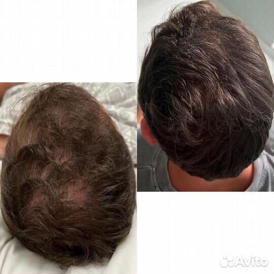 Мезотерапия головы/Восстановление роста волос