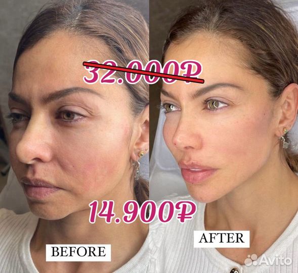 Лицо под ключ Full Face гармонизация обучение