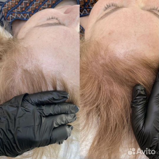 Трихопигментация (SMP) нужны модели