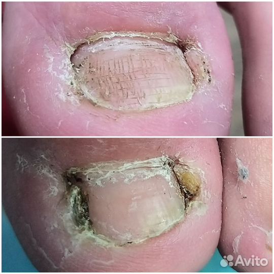 Педикюр сложные случаи