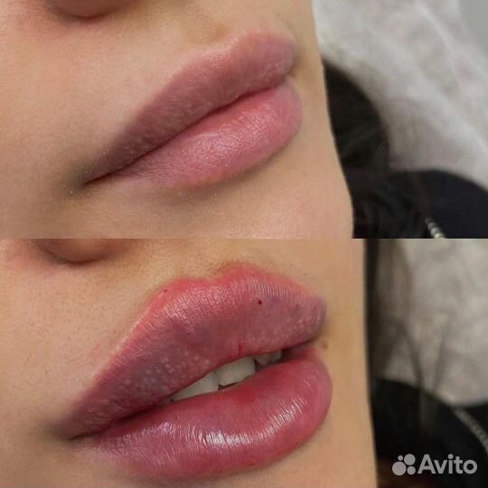 Косметолог: Увеличение губ, контурная пластика