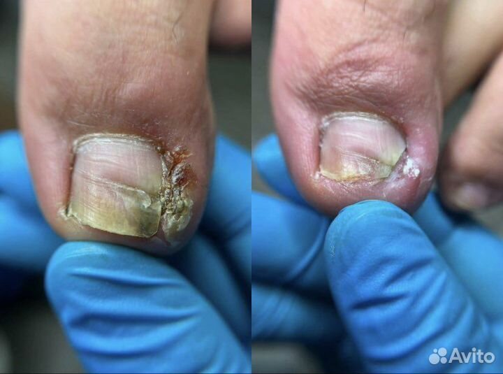 Подолог (сложные ногти и стопы)