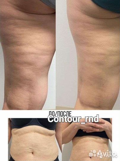 Антицеллюлитный массаж, лимфодренаж, коррекция