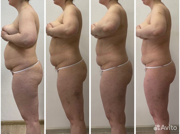 Массаж,lpg,коррекция фигуры