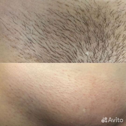 Депиляция воском