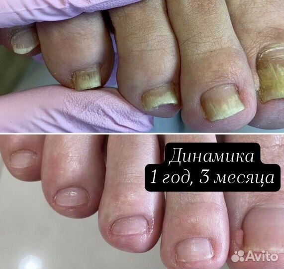 Медицинский педикюр подолог