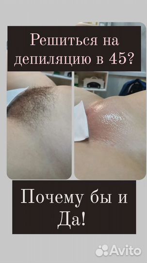 Депиляция, шугаринг