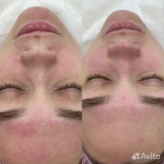 Модель на косметологические процедуры