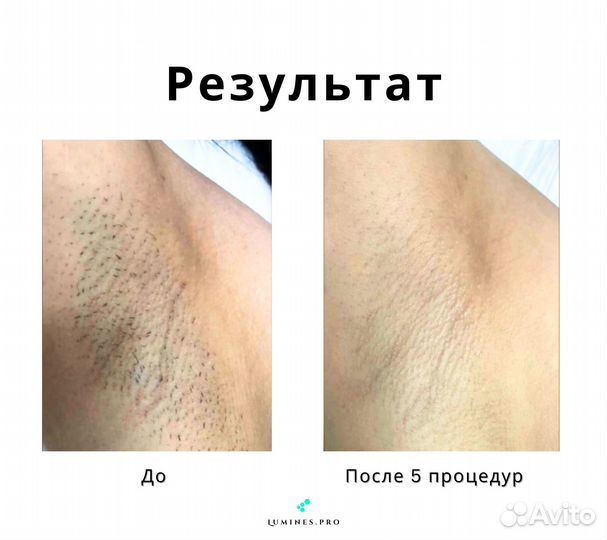 Диодный лазер для эпиляции Lumines’ Макс Ван 1200вт