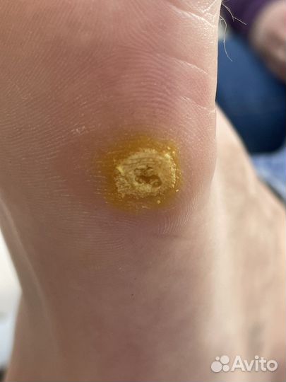 Подолог с выездом на дом