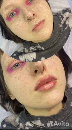 Биоревитализация