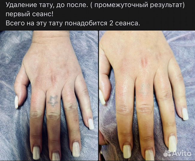 Лазерное удаление тату, татуажа