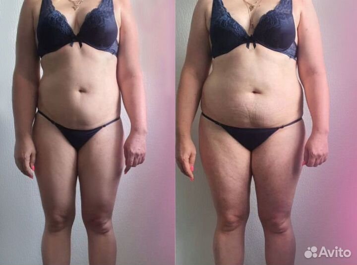 LPG массаж коррекция фигуры