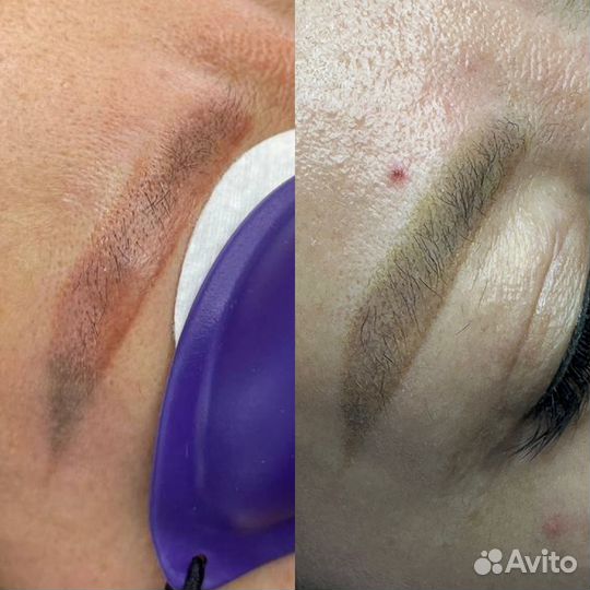 Удаление татуажа