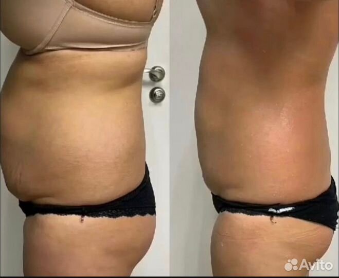 Коррекция фигуры, антицеллюлитный массаж, массаж