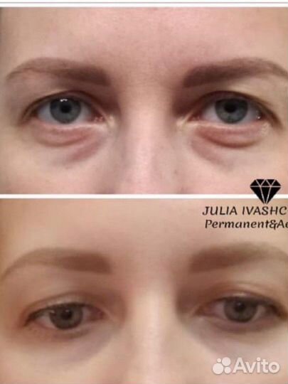 Омоложение