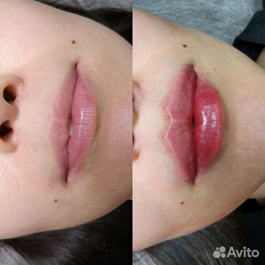 Увеличение губ