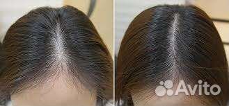 Мезотерапия волос, выпадение, облысение, алопеция