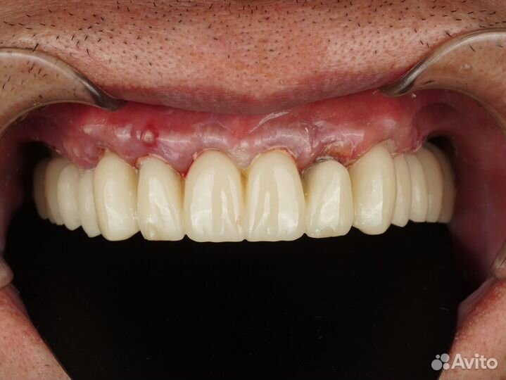 Зубной техник. Моделировка ExoCad. Готовая работа