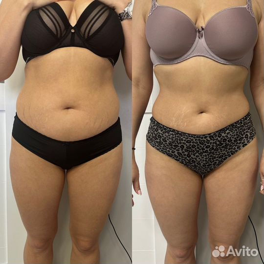 Жиросжигающий массаж, антицеллюлитный, классика