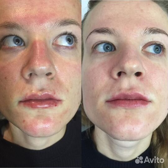 Чистка лица,комплекс (HydraFacial)