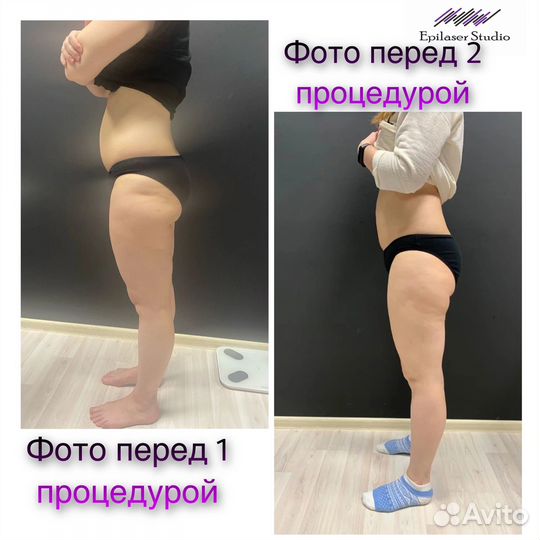 Криолиполиз -минус размер за одну процедуру
