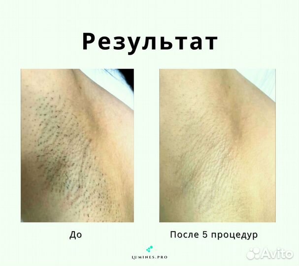 Диодный лазер для эпиляции люминес Max One 1200вт