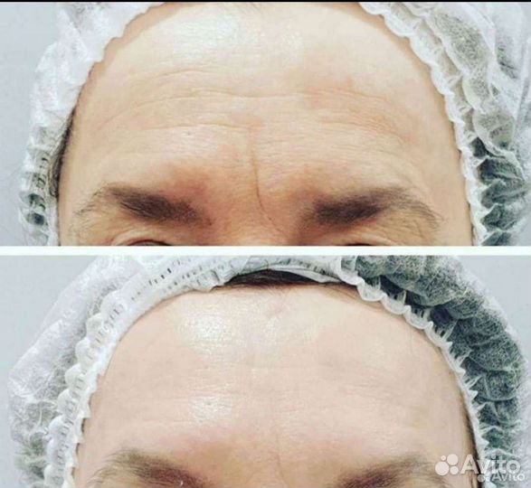 Смасс лифтинг на мощном аппарате 7D