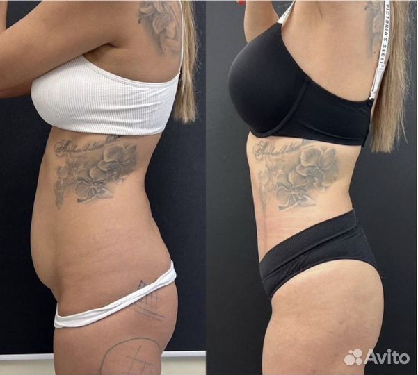 Криолиполиз модель на похудение