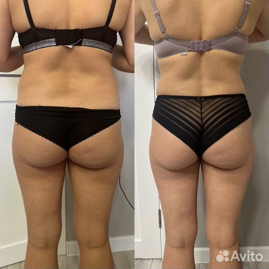 Жиросжигающий массаж, антицеллюлитный, классика