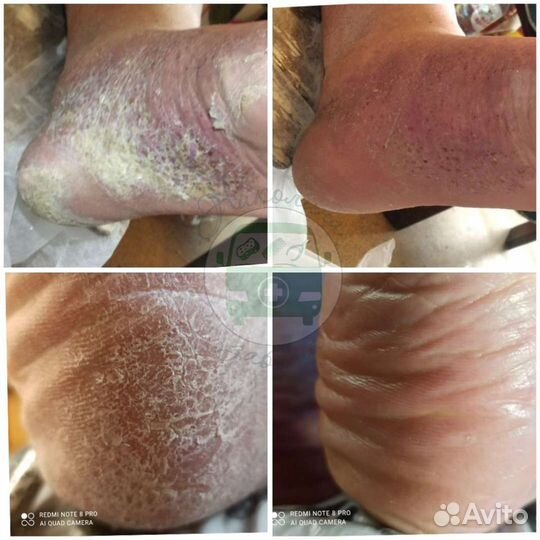 Подолог,медицинский педикюр,педикюр пожилым. Выезд