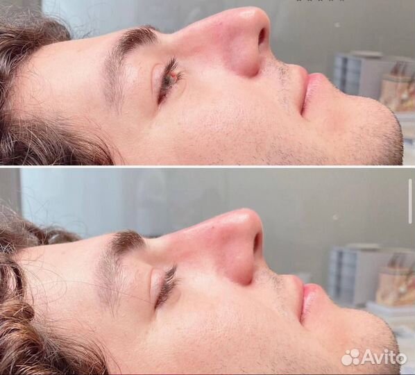 Ринопластика