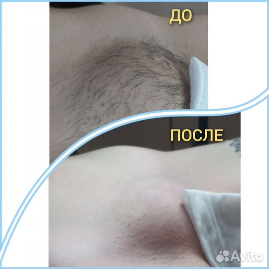 Модель на депиляцию за расходники Девушки