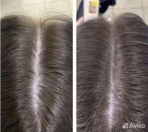 Мезотерапия головы