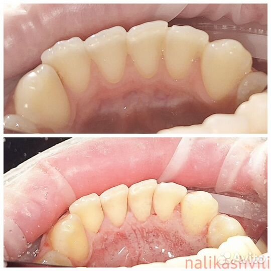 Профессиональная гигиена полости рта